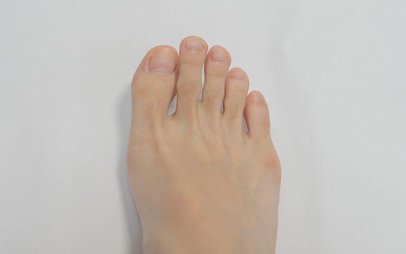 足の小指の痛みは内反小趾が原因？改善方法やグッズを紹介